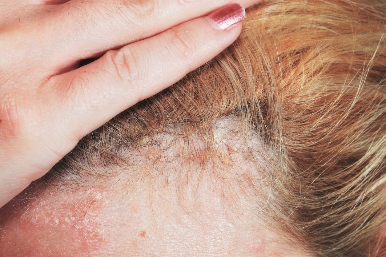 dry scalp